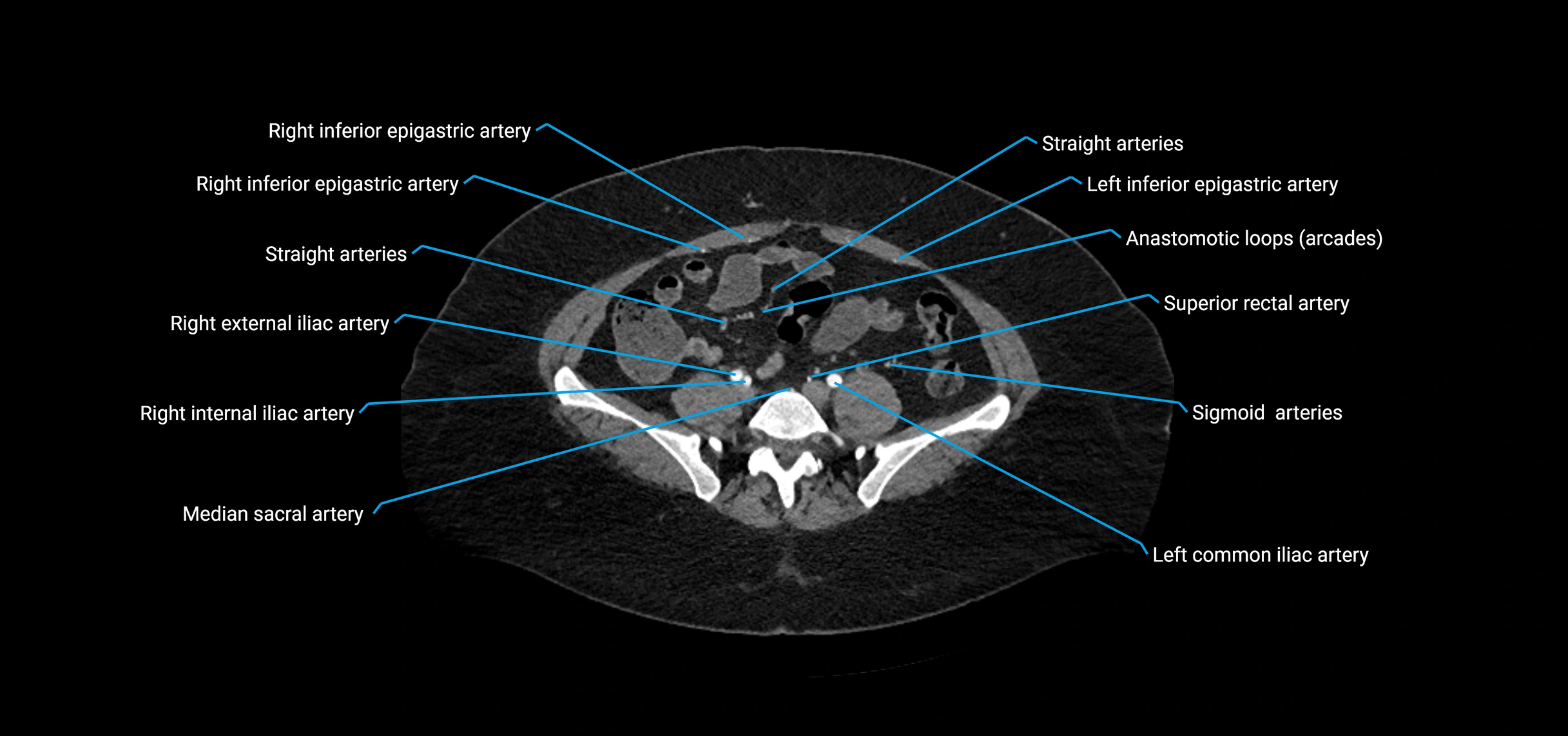 CTA abdomen axial cross sectional anatomy labelled image_168 (2).webp